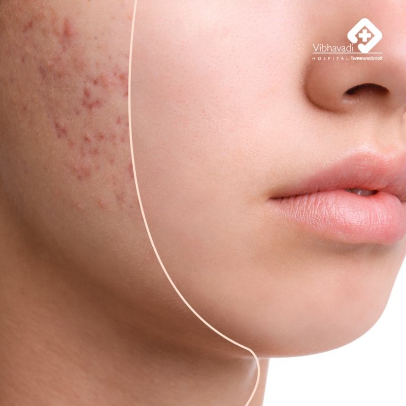 สิว ( Acne & its management )