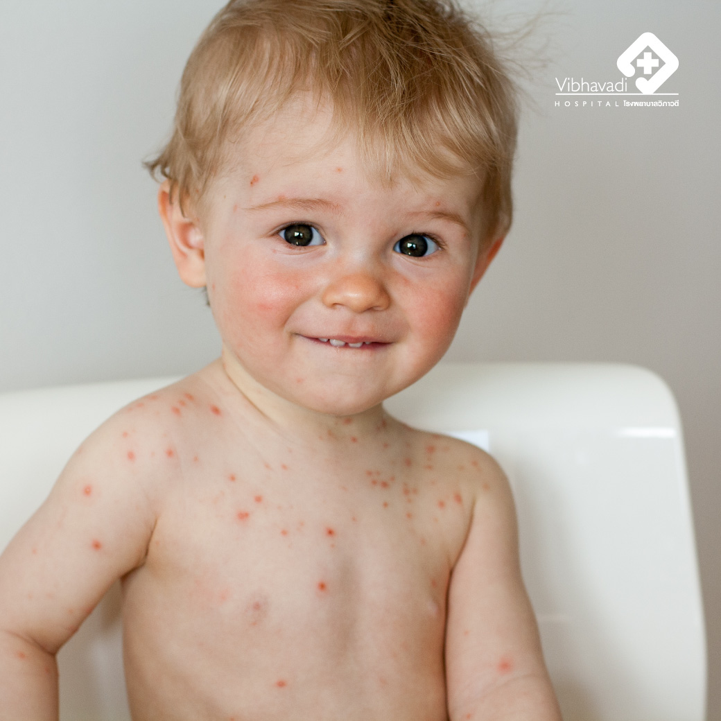 โรคอีสุกอีใส (Chickenpox) เกิดจากอะไร