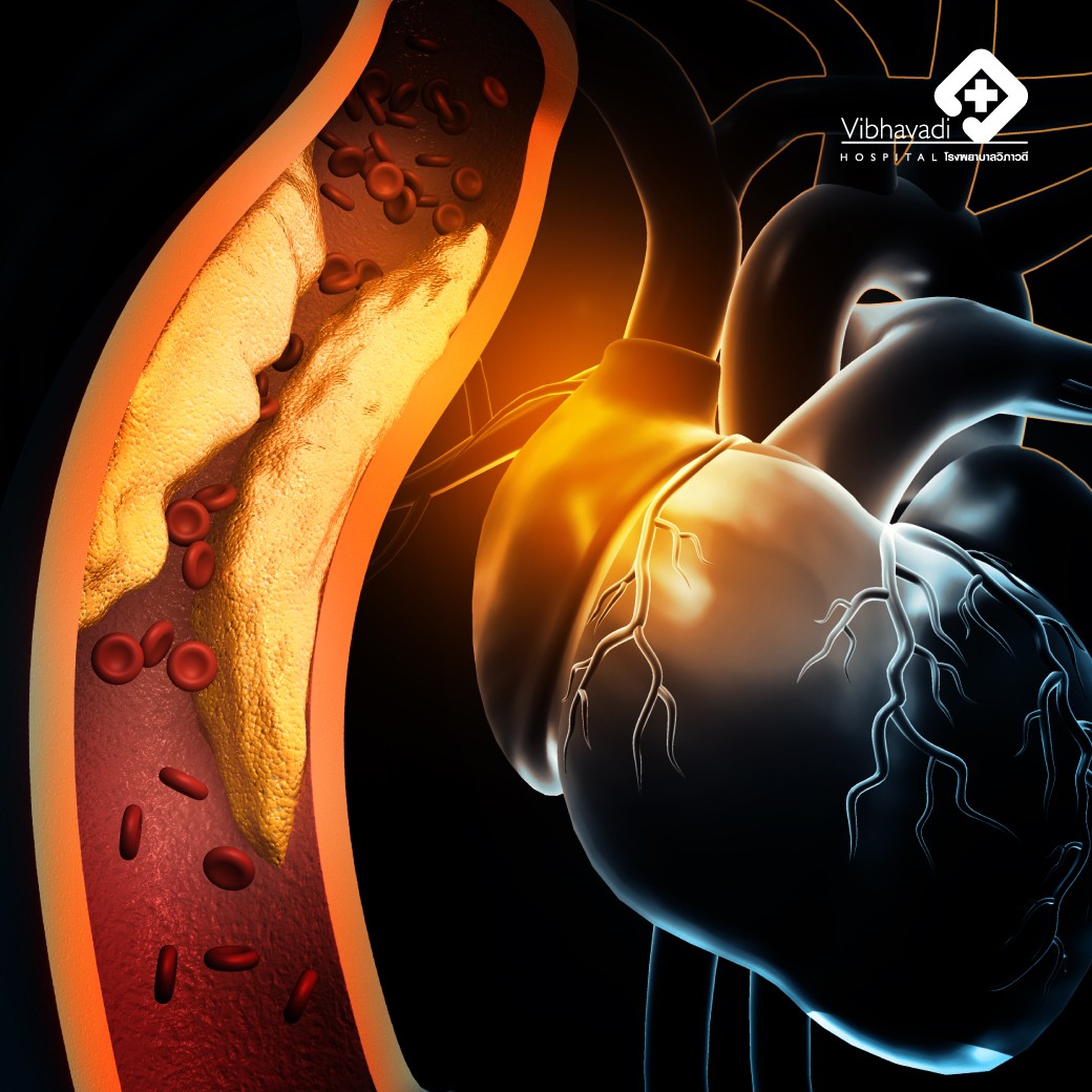 โรคหลอดเลือดหัวใจตีบ และการตรวจหาคราบหินปูนหลอดเลือดหัวใจ (CT Calcium Score)