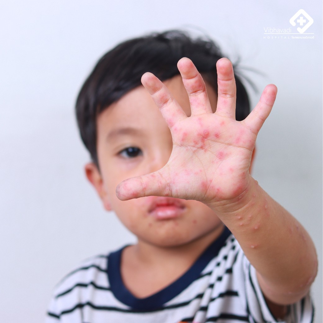 Enterovirus Diseases: Hand, Foot, and Mouth Disease (HFMD) / Herpangina