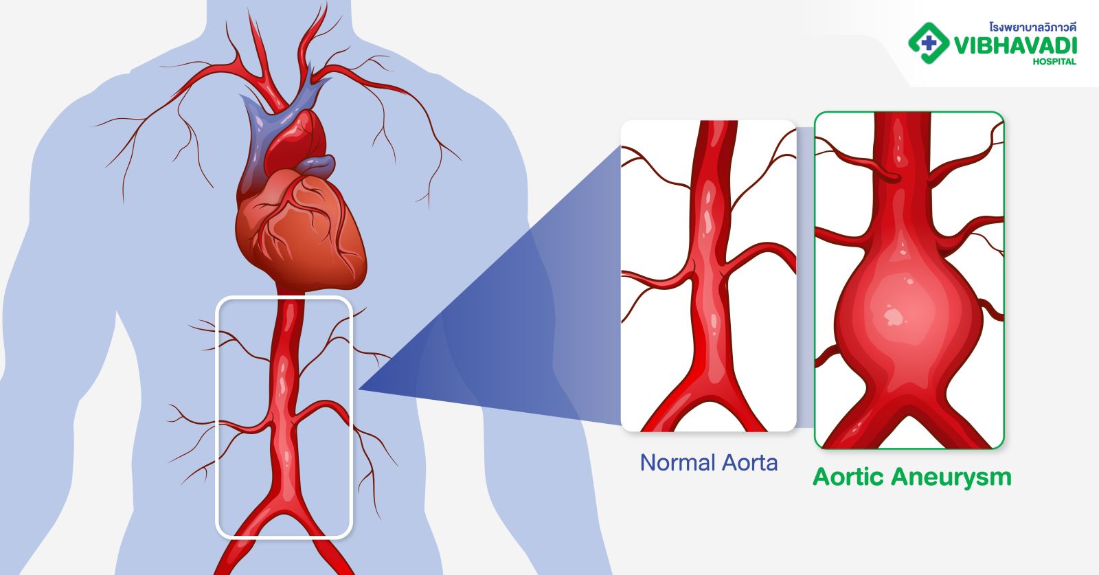 Aortic Aneurysm คืออะไร